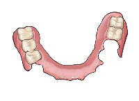 ノンクラスプデンチャー（自費診療）